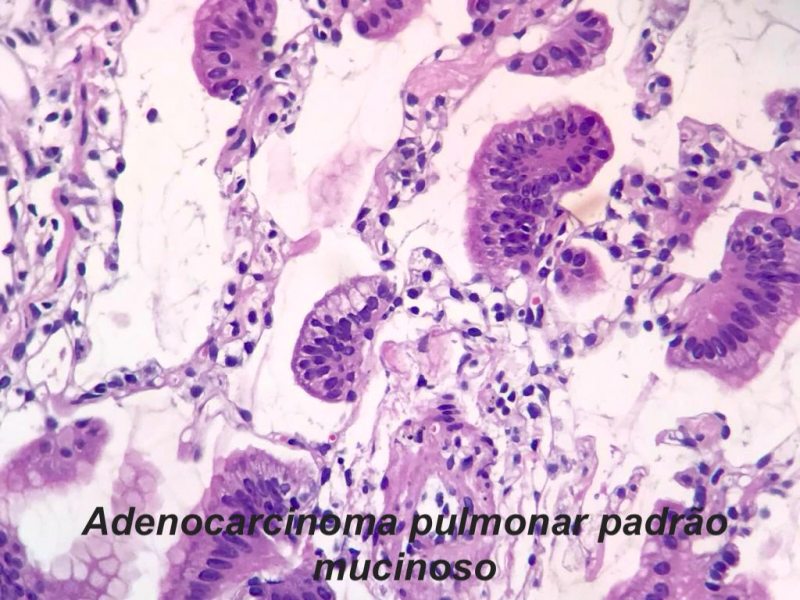 adenocarcinoma pulmonar biopsia