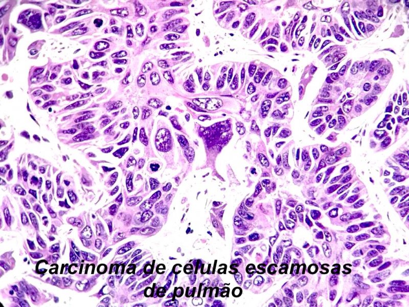 biopsia pulmão patologia citolab