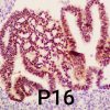 Adenocarcinoma de cérvix relacionado ao HPV (tipo usual)